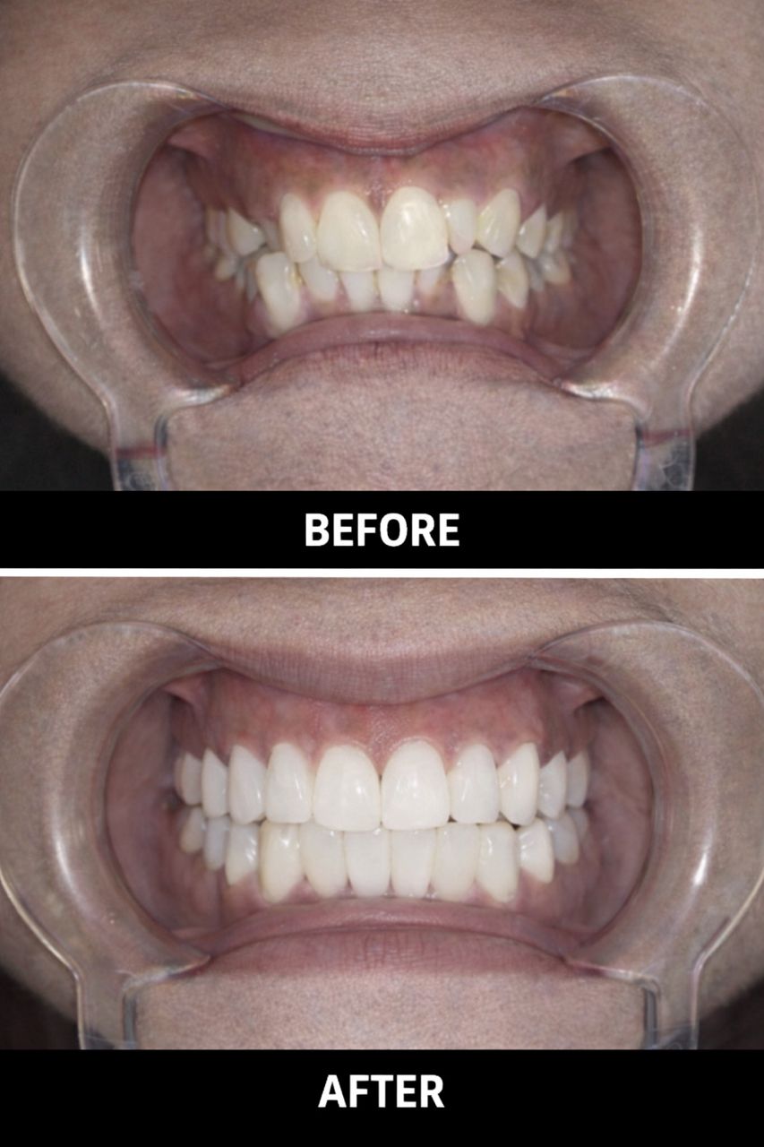 Before After Braces